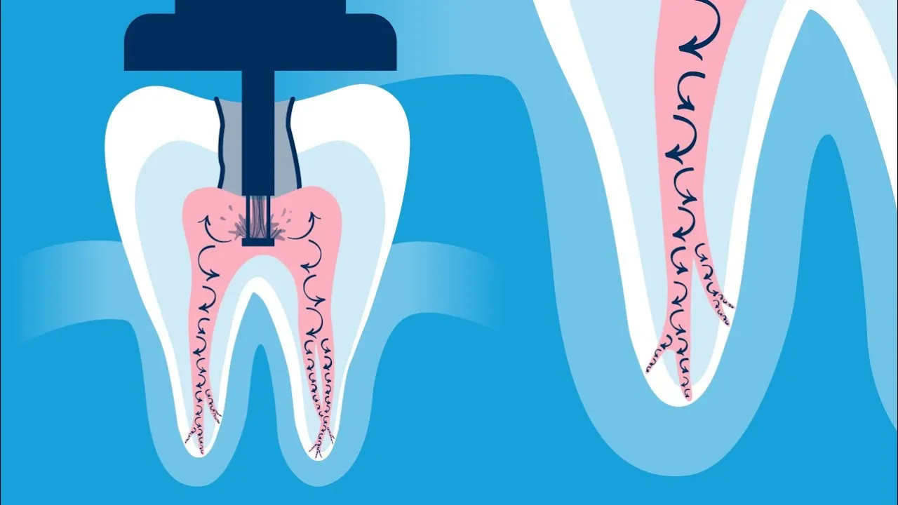 GentleWave UltraCleaning Root Canal Video Thumbnail
